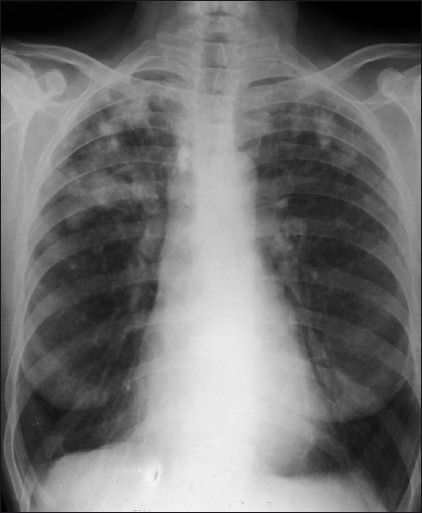 A 70-year-old female: A frontal chest radiograph with features of Caplan's syndrome.
