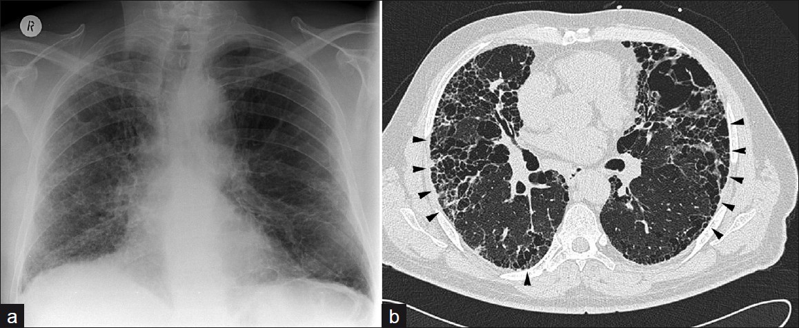 A 63-year-old male: (a) Chest X-ray shows bibasal fibrosis, (b) prone HRCT demonstrates UIP with marked honeycombing (arrowheads) and features of UIP.
