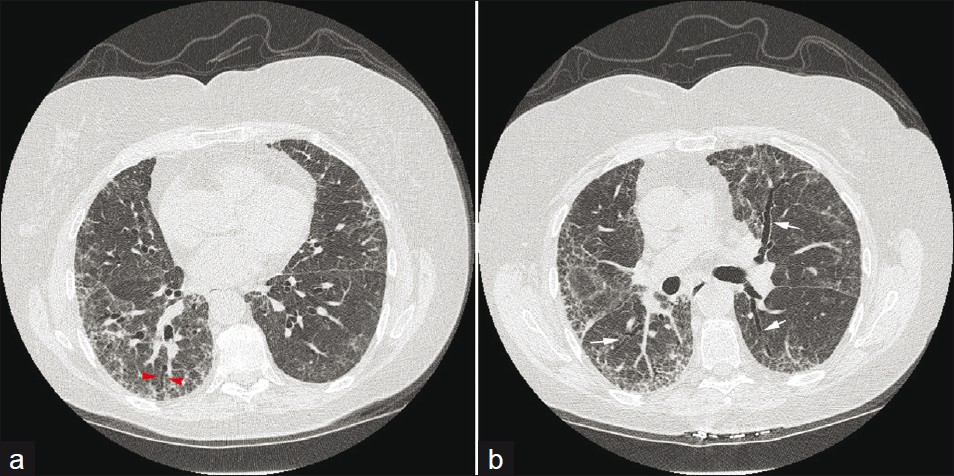 A 65-year-old male: (a and b) axial HRCT sections show NSIP with subpleural ground-glass opacification and traction bronchiectasis (arrows).