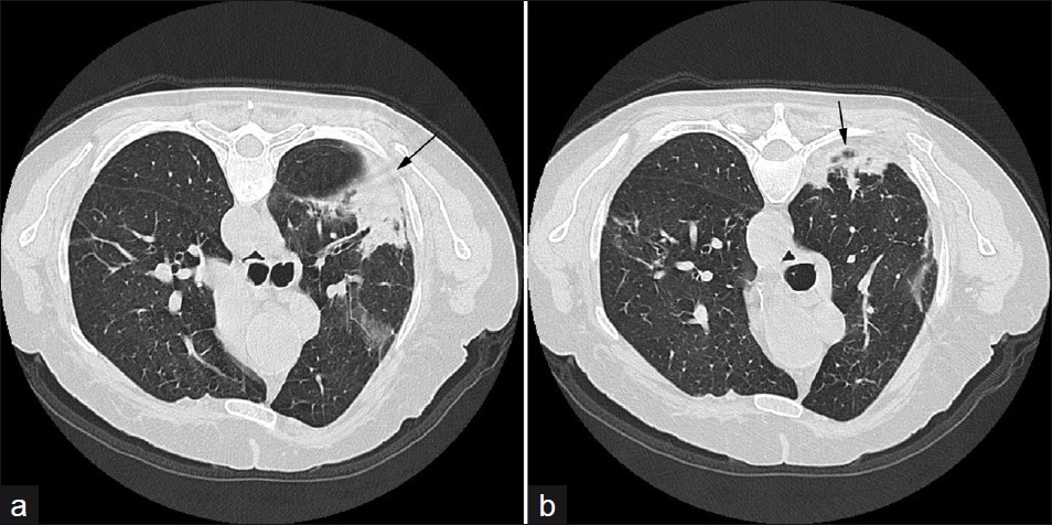 A 74-year-old male: (a and b) axial HRCT show an organizing pneumonia (arrows) in the left lung, attributable to RA.