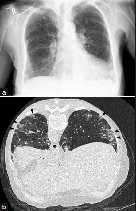 A 73-year-old female with methotrexate-induced lung disease: (a) frontal chest radiograph demonstrates basal reticular shadowing and (b) prone HRCT shows septal thickening, nodularity, and basal fibrosis (arrowheads); consistent with NSIP. Improvement was seen following cessation of the drug.