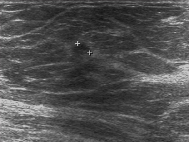 Shape: Oval sonographic appearance of infiltrating ductal carcinoma.