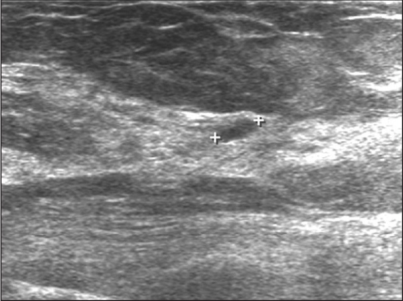 Lesion boundary: This malignant lesion shows an abrupt interface.