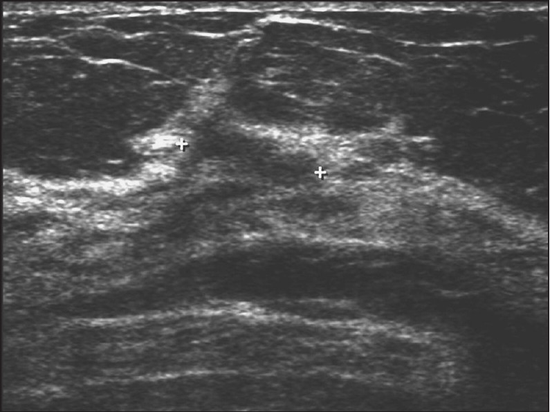 Orientation: Lesion parallel to skin that mimics a fat lobule. Ductal carcinoma in situ and infiltrating ductal carcinoma were confirmed by core biopsy.