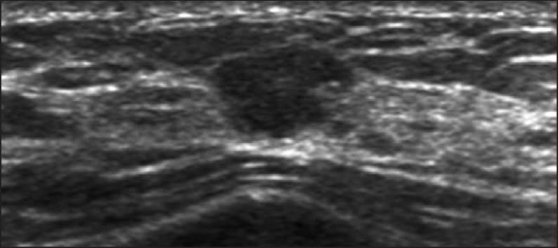 Echogenicity: Hypoechoic lesion, infiltrating ductal carcinoma was obtained at histology.