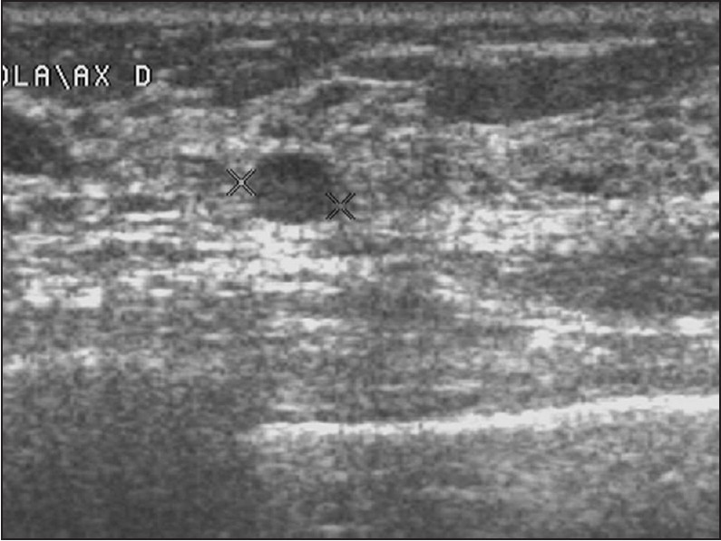 Margin: A round lesion with well-defined margin not suspected of malignancy. Core biopsy showed malignant histology.