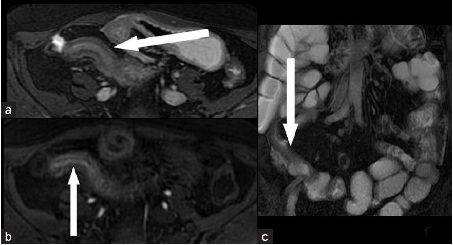 A 32-year-old woman with a fibrotic stenosis of the terminal ileum. Low signal intensity in T2-weighted FRFSE fat-suppressed sequences seen in (a) axial scan (arrow) and (c) coronal scan: (arrow). (b) Very low enhancement 60 s after i.v. administration of paramagnetic contrast medium is seen on axial “Lava” T1-weighted scan (arrow).