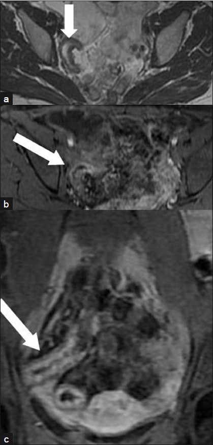 A 31-year-old woman with an active inflammatory stenosis of the terminal ileum: (a) Moderate signal intensity in an axial T2-weighted FRFSE sequence (arrow). (b) High enhancement in “Lava” T1-weighted sequences axial scan 60 s after i.v. administration of paramagnetic contrast medium (arrow). (c) Coronal scan 120 s after injection (arrow).