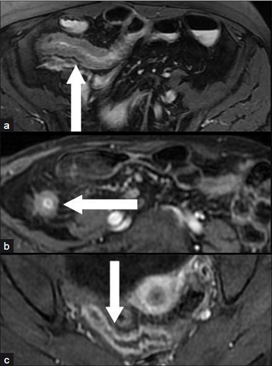 Three different patients: (a) a 25-year-old man, (b) a 34-year-old man, (c) a 45-year-old woman with an active inflammatory stenosis of a distal ileal loop (axial scans). Moderate signal intensity in a T2-weighted FRFSE fat-suppressed sequence (arrow in a); High enhancement in “Lava” T1-weighted sequences 60 s after i.v. administration of paramagnetic contrast medium (arrows in b and in c).