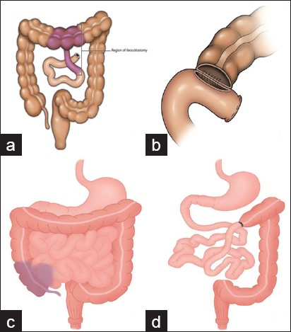 (a-d) Line diagrams show ileocolonic anastomosis between ileum and transverse colon.