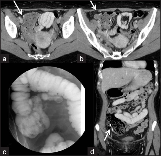 (a,b) Axial and (d) coronal CT images and (c) barium enema image depict ileocolonic anastomosis.