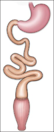 Line diagram depicts ileorectal anastomosis.