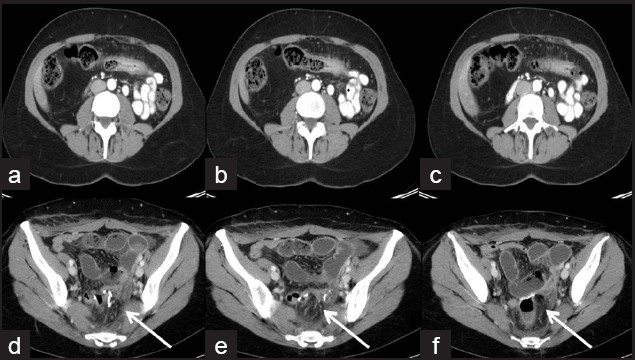 (a-c) Axial CT images demonstrate thickening of transverse colon in this patient with Crohn's disease; (d-f) Managed by total colectomy with ileorectal anastomosis.