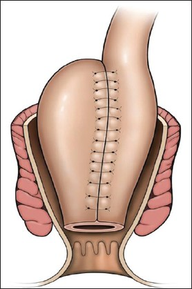 Line diagram depicts an ileoanal pouch.