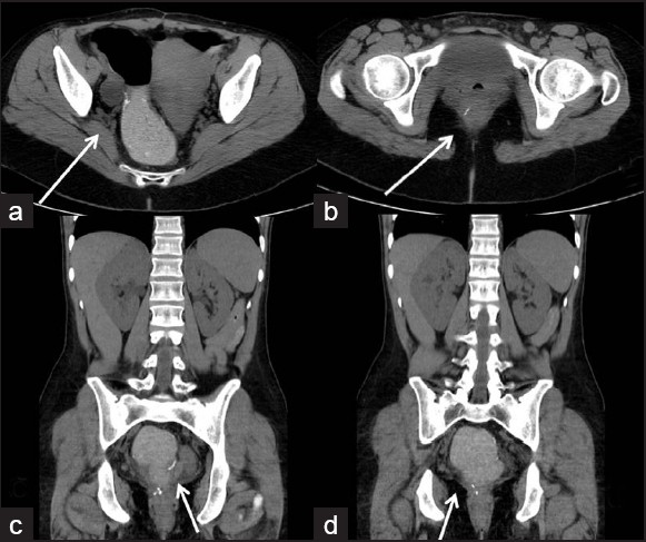 (a-d) Axial and coronal CT images showing ileoanal pouch after proctocolectomy.