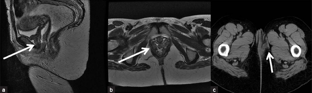 Thirty-two-year old female patient with Crohn's disease complicated by proctoolitis which was managed by total proctoolectomy and ileoanal pouch developed fistula between rectum and vagina. T2-weighted (a) sagittal and (b) axial MR images show the fistulous track (arrows). This was managed by fistulotomy and a gracilis interposition flap seen on (c) axial CT image (arrow).