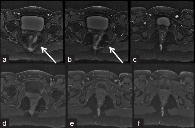 Twenty-three-year-old female with perianal fistula and perirectal collection seen on (a-c) T2 and (d-f) postcontrast MRI; managed by drainage and seton placement.