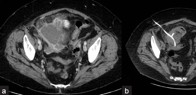 Sixty-two-year-old lady with Crohn's disease who developed a pelvic abscess, (a) seen on axial postcontrast CT image (b) which was percutaneously drained.