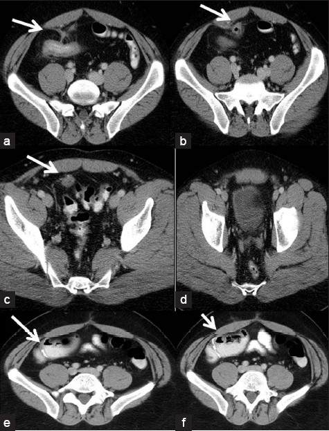 (a-d) Axial CT images show thickened ileum with a collection/sinus tracking to bladder. Managed by ileocecectomy with drainage of abscess and ileocolonic anastomosis seen on (e-f) axial CT images.