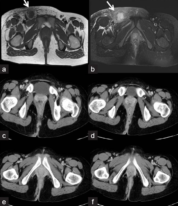 Twenty-one-year-old female patient with Crohn's disease presenting with right inguinal abscess seen on (a,b) axial MR images as hypointense collection on T1 images which is hyperintense on T2 images. Incision and drainage of abscess done with antibiotics administered. Presented 9 months later with perirectal fistula seen on (c-f) these axial CT images posteriorly on the right side and managed by seton and abscess drainage. The inguinal abscess has completely resolved on these images.
