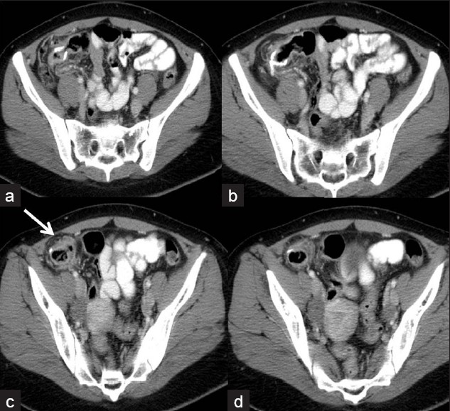 Mild thickening around recent ileocolonic anastomosis seen on (a-d) these axial CT images which is likely postoperative/reactive