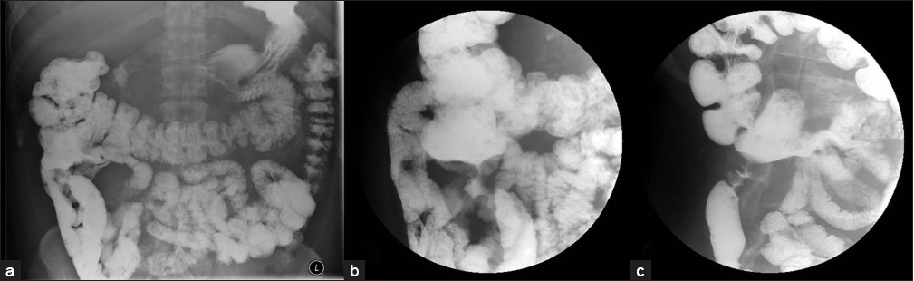 (a-c) Small bowel series images show narrowing of the ileocolonic anastomosis.