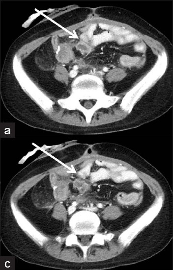 (a,b) Axial CT images show small fluid collection around site of anastomosis suggesting breakdown.