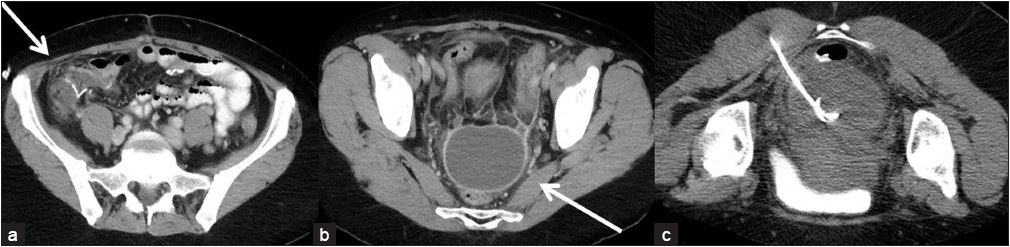 (a) Three-weeks postileocolic resection with small collection adjacent to anastomosis and (b) new pelvic collection (c) which was drained percutaneously.