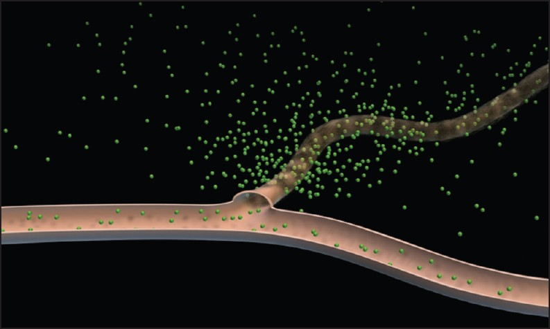 Schematic diagram depicting leakage of an intravenous contrast agent through leaky tumor vessels; normal vessels are relatively impermeable to such agents (Adapted with permission from Barrett et al. EJR 2006; 60(3): 353-366).
