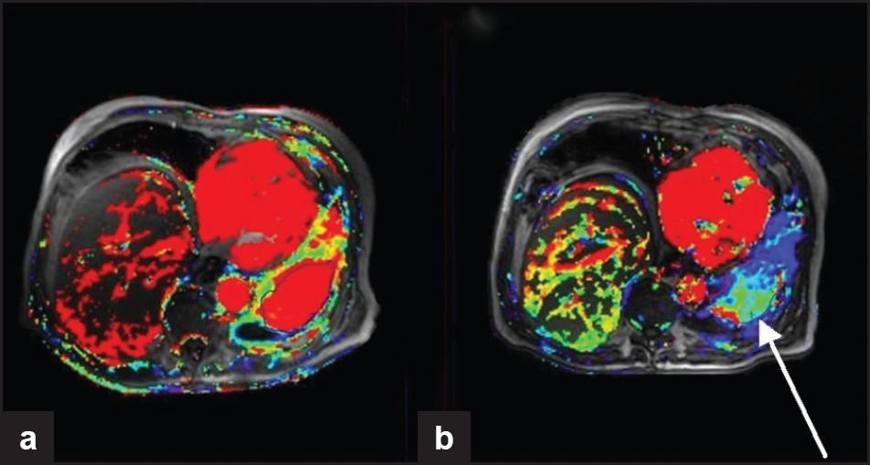 DCE-MRI from a clinical trial of sorafenib (anti-angiogenic agent targeting VEGF and PDGF) for the treatment of squamous cell lung cancer. Ktrans maps (a measure of tumor permeability) obtained at (a) baseline and (b) 6 weeks after treatment. Although there is little change in lesion size, the Ktrans maps show reduced vascularity (arrow) indicating successful anti-angiogenic therapy.