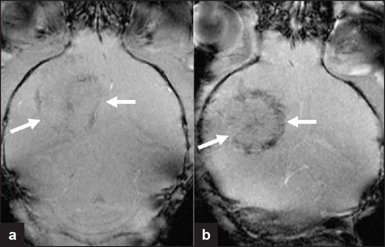 Iron-labeled endothelial precursor cell imaging in a murine glioma model. MR images of tumor after implantation of (a) unlabeled and (b) iron-labeled 6stem cells. Histology confirmed the presence of iron within the tumor, secondary to tracking of the labeled cells to regions of increased endothelial proliferation/neo-vascularization. This is noted to be predominantly at the tumor periphery, where angiogenesis is maximal (Reproduced with permission from reference 5).