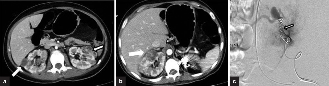 (a-c) A 39-year-old woman with tuberous sclerosis. Axial contrast-enhanced CT images though the abdomen show multiple bilateral fat density lesions consistent with renal angiomyolipomas. Angiogram image demonstrates coiling of an aneurysm within an angiomyolipoma in the left kidney. The contrast-enhanced CT image on the right demonstrate volume loss in the left kidney following embolization