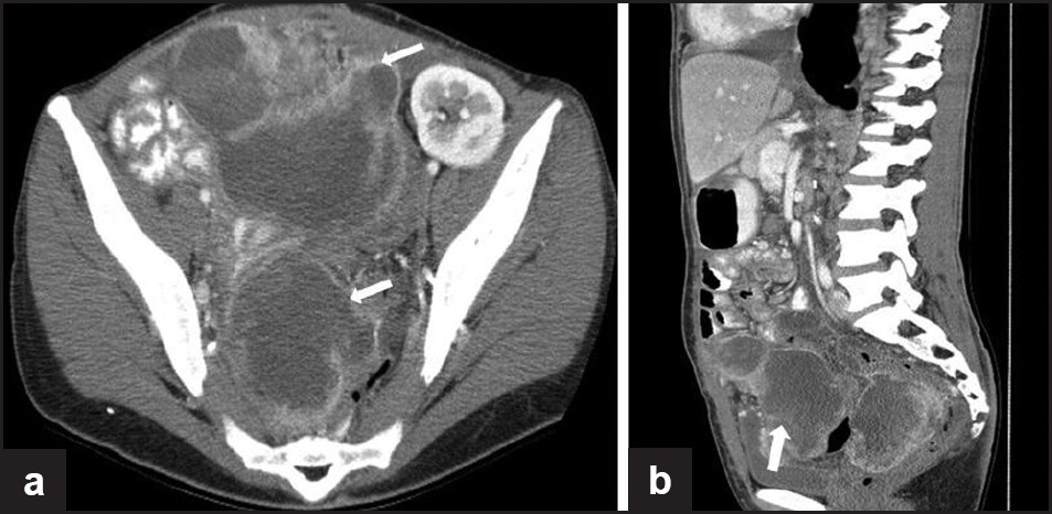 A 35-year-old female with tuberous sclerosis and lymphangioleiomyomatosis. Status post-renal transplant. (a) Axial and (b) sagittal contrast-enhanced CT images show large, irregular, low-attenuation enhancing, peripherally enhancing masses in the pelvis in a patient with tuberous sclerosis, biopsy proven as PEComa (perivascular epitheliod cell tumor). Also note the transplant kidney in the left pelvis