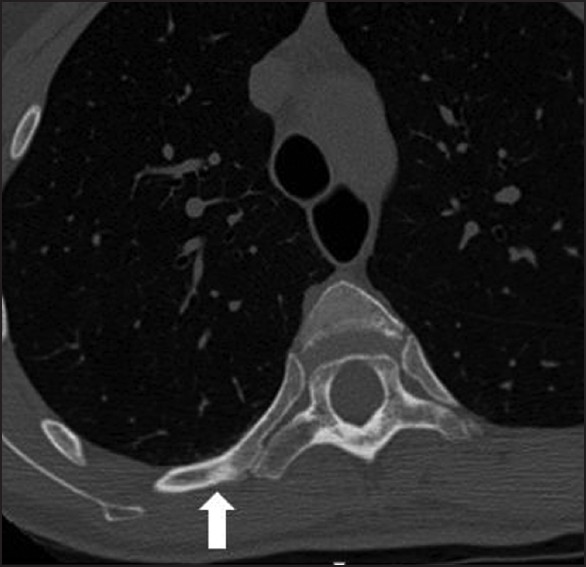 A 30-year-old with tuberous sclerosis. Axial noncontrast chest CT demonstrates multiple small sclerotic lesions in the ribs and vertebrae