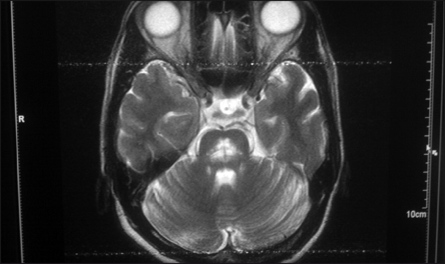 T2 axial MRI shows central pontine hyperintensity with sparing of the periphery.