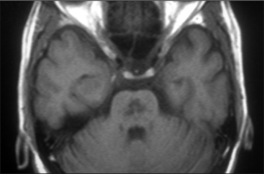T1 axial image shows hypointense lesions in the pontine region and at the periphery of the pons. Central pontine myelinolysis is a likely diagnosis, however, involvement of the temporal lobe and clinical features makes central pontine myelinolysis unlikely.