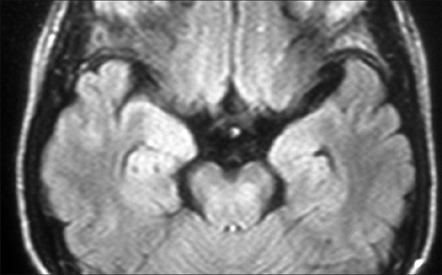 FLAIR axial MRI image shows bilateral temporal lobe lesions and involvement of the pons. The lesions are hyperintense involving the central pons and anterior part of the temporal lobes. The temporal lobe lesions are symmetrical and bilateral. Bitemporal involvement is characteristic of herpes simplex encephalitis, while basal ganglia and thalamic involvement is characteristic of japanese encephalitis.