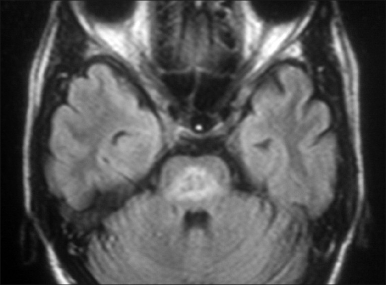 FLAIR axial MRI image shows well delineated pontine lesions. Pontine lesions and extra temporal involvement in herpes simplex encephalitis is rare.