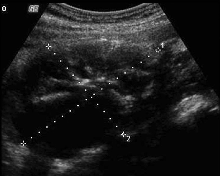 Transabdomen grayscale US image shows a heterogeneous lesion demonstrating solid and cystic portions arising from the left ovary.