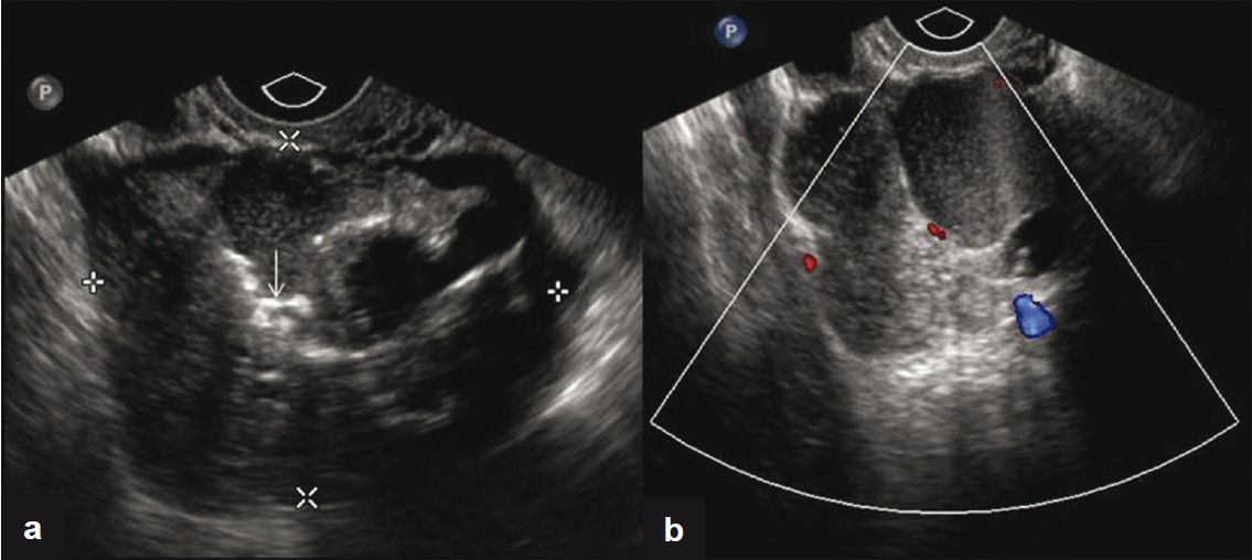(a) Transvaginal US image shows a complex mass with solid and cystic components and calcifications (arrow). (b) Corresponding color flow Doppler image of the lesion.