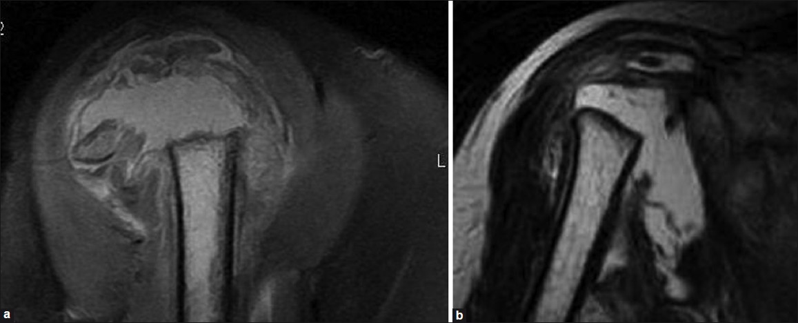 MRI of right shoulder. (a) Sagittal proton density fat suppressed image showing destruction of the head of the humerus with sharp margins and large amount of joint effusion. (b) Coronal T2 weighted image showing superior subluxation of the head of the humerus with multiple bony fragments. Destruction of surrounding muscles is also noted.