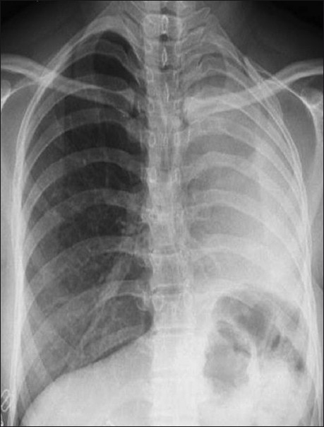 Aplasic image of the left lung.