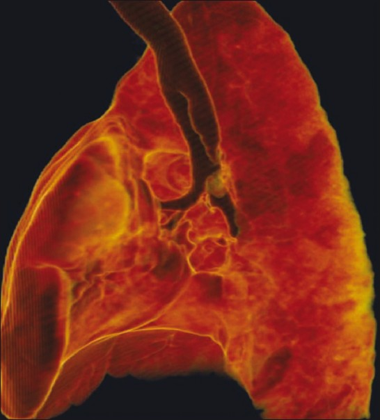Rudimentary left main bronchus.