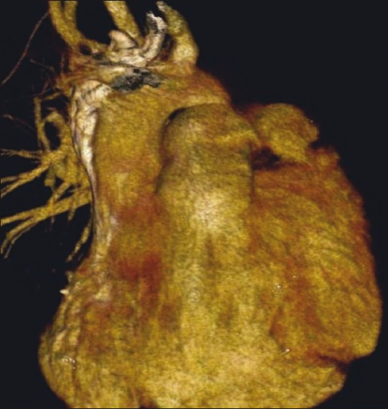 The image of nonexistent left pulmonary artery and rudimentary left pulmonary vein.