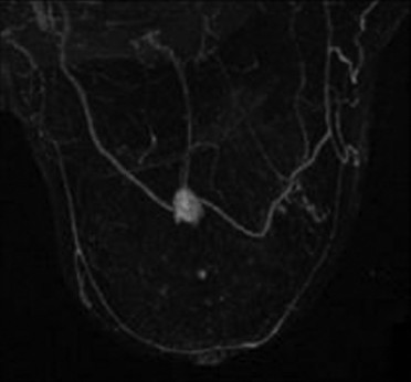 Fibroadenoma. MIP image demonstrates an enhancing mass without spiculations or microlobulations.