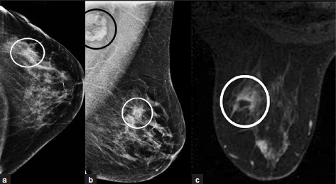DCIS. (a) CC and (b) MLO views of left breast with microcalcifications (not well projected), soft tissue density, and biopsy clip in the outer aspect (white ovals). Axillary lymphadenopathy (black oval) is noted on the MLO view. (c) Post-contrast MR image of left breast showing clumped non-masslike enhancement in the outer aspect (oval). Note central low-signal artifact from a biopsy tract.