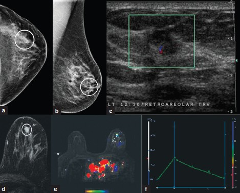 Invasive ductal carcinoma. (a) CC and (b) MLO views of the left breast demonstrate an irregular mass with indistinct spiculated margins (white ovals) (c) Ultrasound image demonstrates a taller-than-wide hypoechoic irregular mass with indistinct margins. (d) Postcontrast MR images demonstrate heterogeneous enhancement of the mass (oval). Note (e) the color map overlay and (f) type III enhancement curve of the mass.