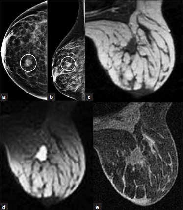 Posttreatment seroma. (a) CC and (b) ML views of the right breast from initial screening mammogram demonstrates a mass in the inner aspect (oval, a). This was found to be invasive lobular carcinoma and the patient underwent lumpectomy. MRI exam 6 months after lumpectomy demonstrates a lesion in the surgical bed that is (c) hypointense on T1WI, hyperintense on (d) T2WI, and shows (e) mild contrast enhancement. This lesion is consistent with a postoperative seroma.