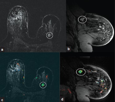 Cancer recurrence. (a) MIP axial and (b) sagittal and (c) color map overlay axial and (d) sagittal MR images demonstrate an asymmetrically smaller left breast related to lumpectomy for invasive ductal carcinoma. In the deep 12:00 position of the left breast there is an irregular, enhancing mass with spiculations (white oval) consistent with biopsy-proven recurrence of invasive ductal carcinoma.