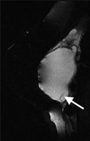 Intra- and extracapsular silicone implant rupture. STIR MR image demonstrates hyperintense silicone within the extracapsular soft tissues and within implant shell folds (arrow).